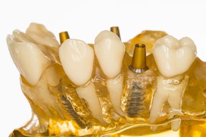 Modell eines Dentalimplantates
