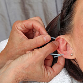 Nadeln im Ohr bei der traditionellen chinsischen Akupunktur
